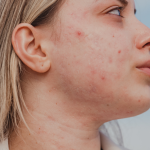 Acne-safe rutina: Šta raditi, a šta izbjegavati kad se borite s aknama