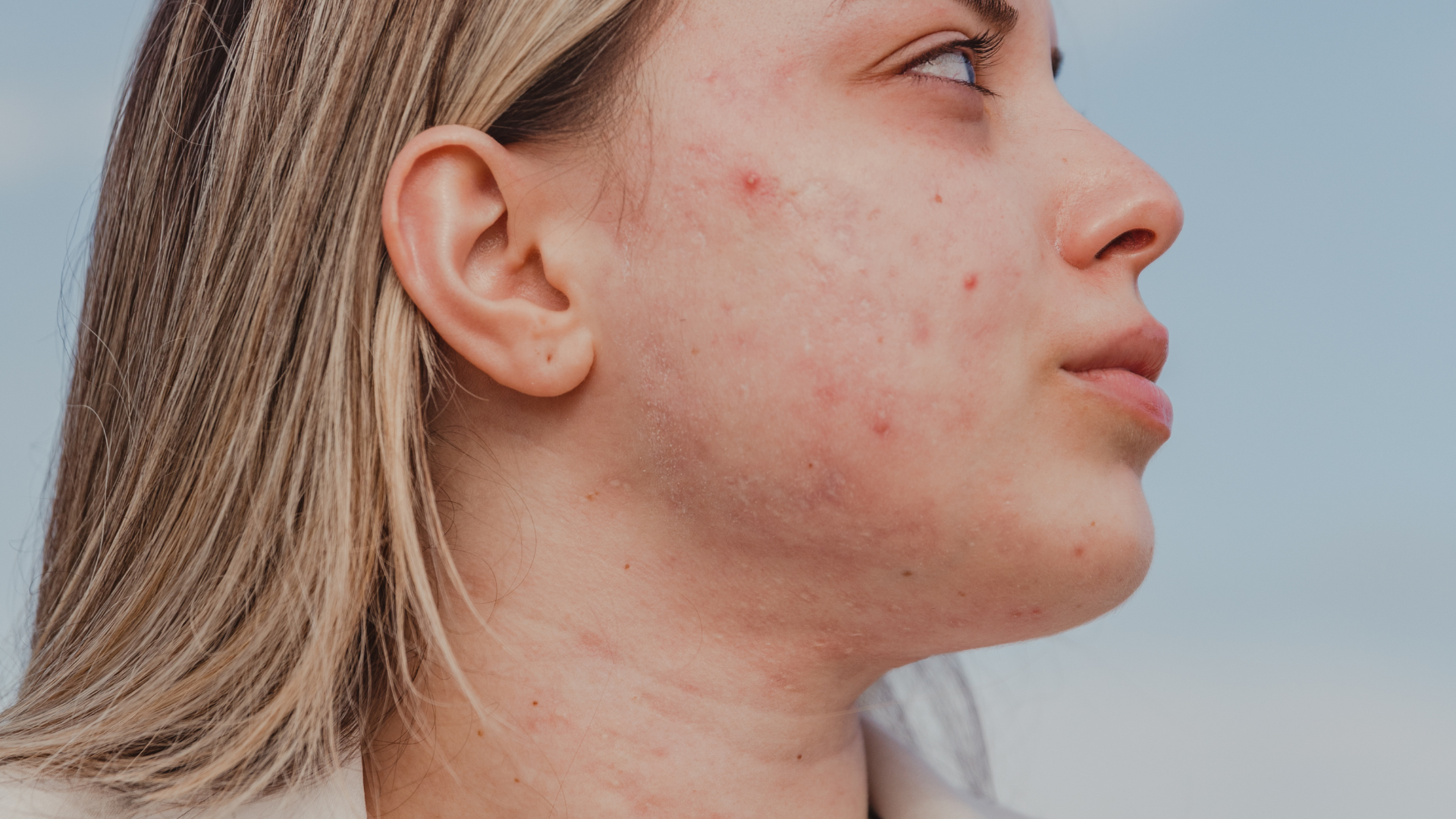 Acne-safe rutina: Šta raditi, a šta izbjegavati kad se borite s aknama