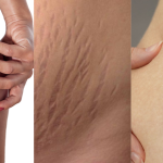 Strije: Real talk, šta se može, a šta se ne može promijeniti