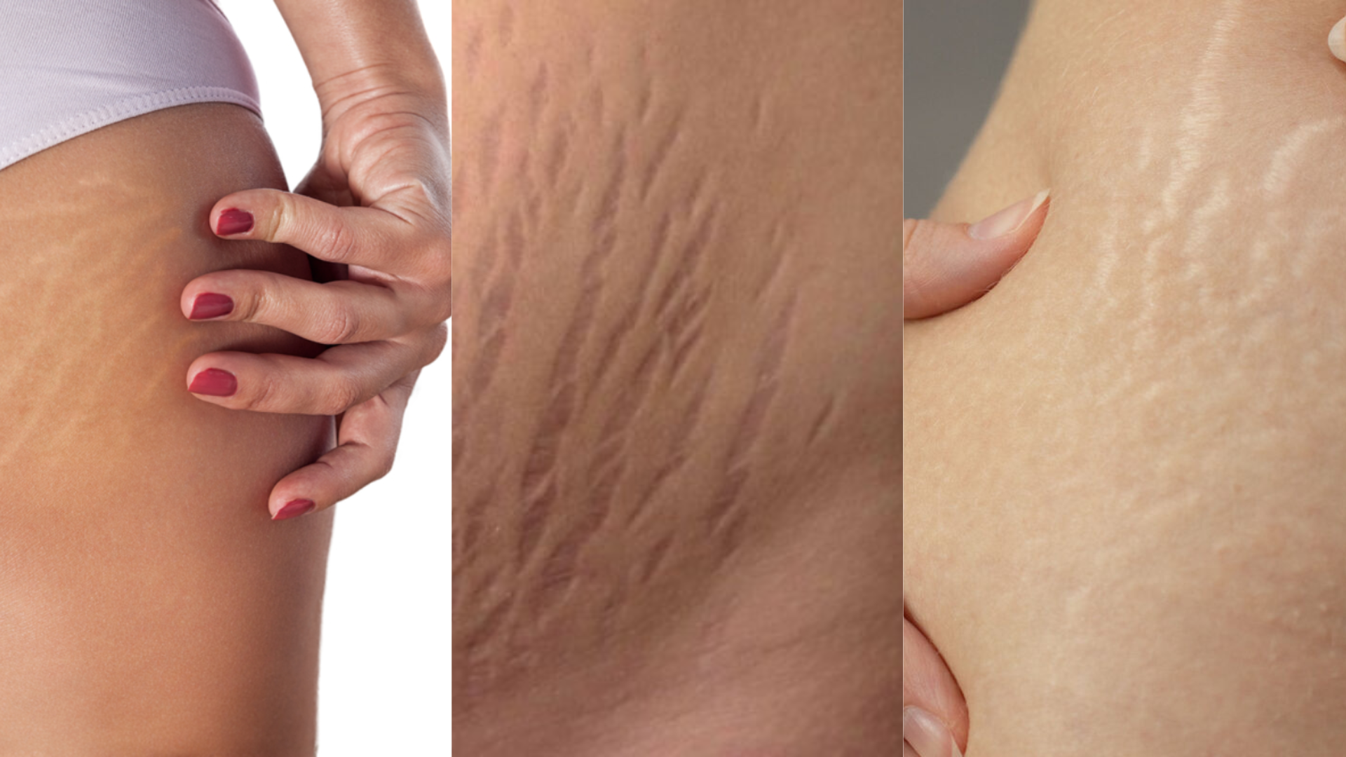 Strije: Real talk, šta se može, a šta se ne može promijeniti